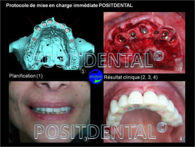 Protocole de mise en charge imm diate positdental 002 w7rkcs - Eugenol