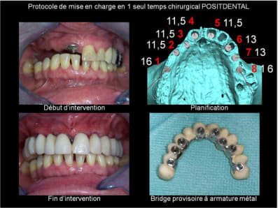 Protocole de mise en charge imm diate positdental 007 omfrwl - Eugenol