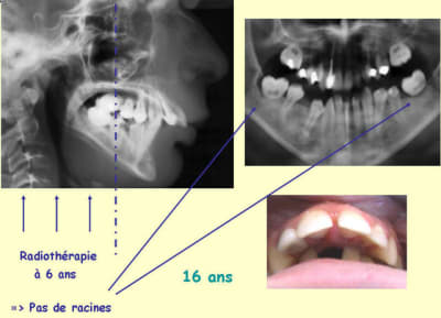 Radiotherapie qcsnjy - Eugenol