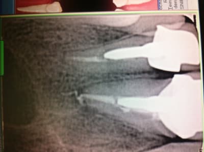 Retro incisive ekj3gp - Eugenol