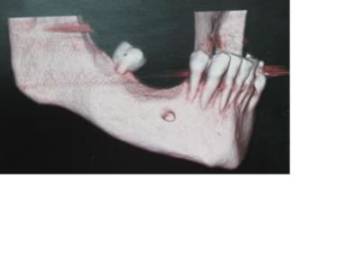 Scan 3d dkgcwb - Eugenol