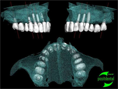 Simullation implantaire 3d positdental j6jlub - Eugenol