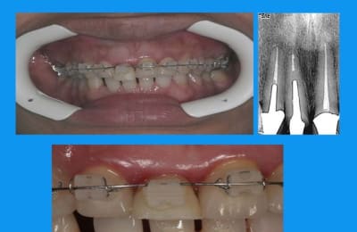 Traction 2  xl9s5e - Eugenol