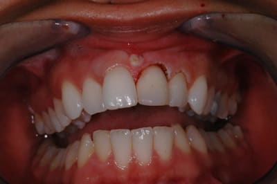 Teix correction apres ebhmod - Eugenol