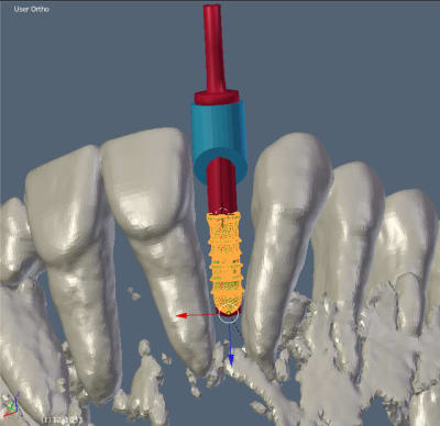 Twistdrillwithimplantandcylinder gl15a4 - Eugenol