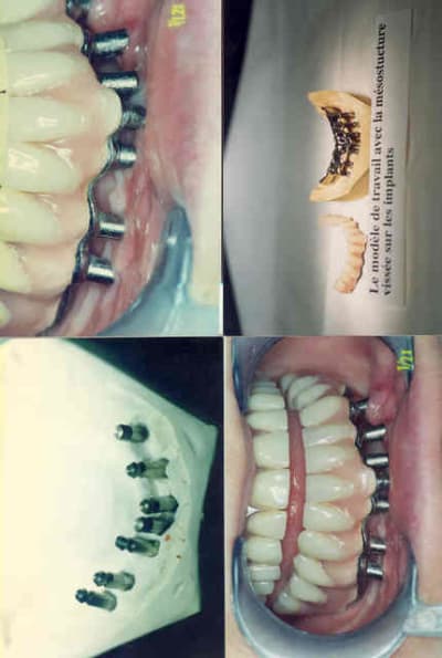 Un cas de diskimplants gx6dfa - Eugenol