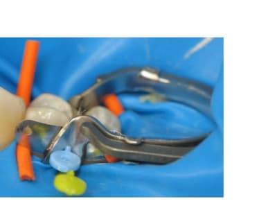 V ring chshis - Eugenol