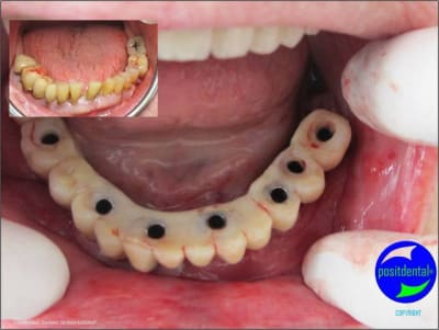 Wax up 3d positdental 11 sbcfs5 - Eugenol