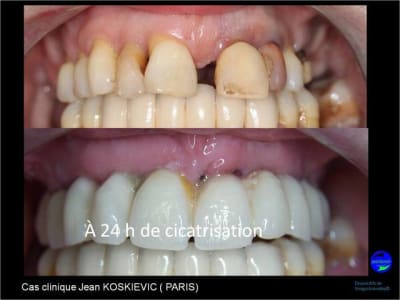 Wax up 3d positdental 2 r7xv3j - Eugenol