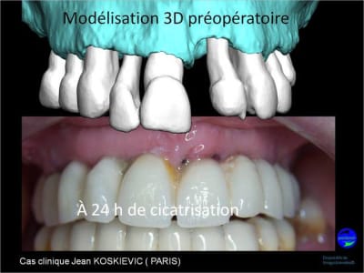 Wax up 3d positdental 3 jdapns - Eugenol