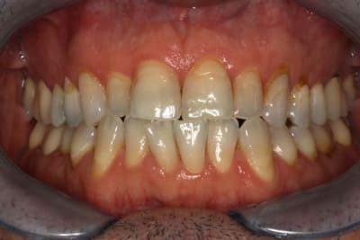  tat initial occlusion cpryzi - Eugenol