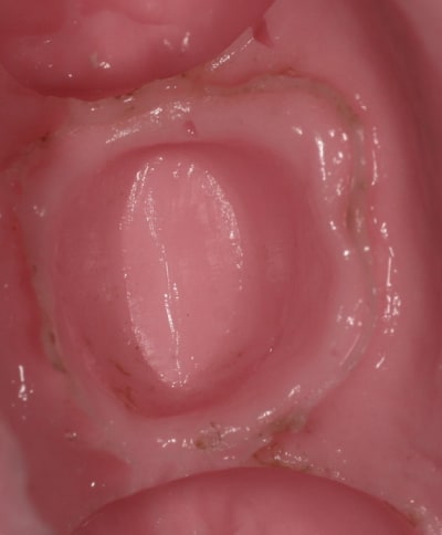 Alginate bpowvn - Eugenol