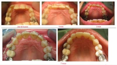 Alignement et contention ho9wsg - Eugenol