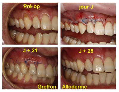 Alloderme  secteur 1  kalgpc - Eugenol