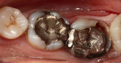 Amalgame dentaire w3xca4 - Eugenol