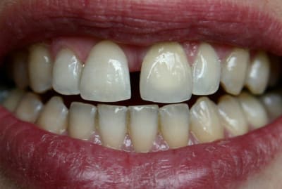 Ap2 sdd5hd - Eugenol