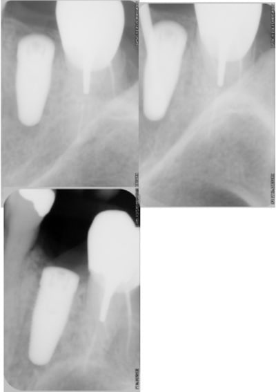 Apex infect  bmqswq - Eugenol