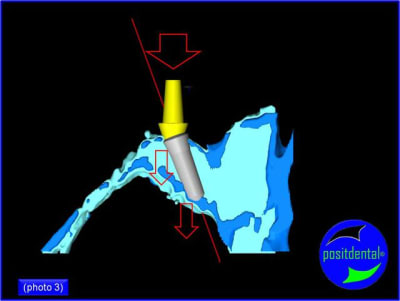 Armature m tal rigide pour mci positdental 3 kspmqz - Eugenol