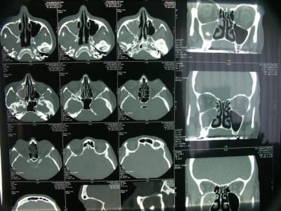 Aspergillose qliuk8 - Eugenol