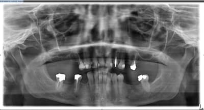 Avant opqvab - Eugenol