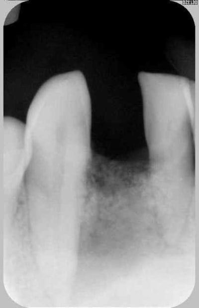 Avt implant guwwqi - Eugenol