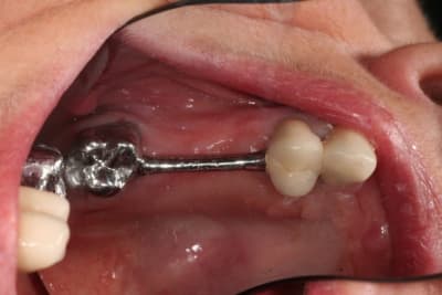 Barre maxillaire zdf1qb - Eugenol