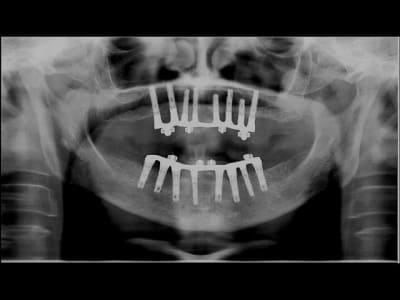 Barres sur oring zzlqax - Eugenol