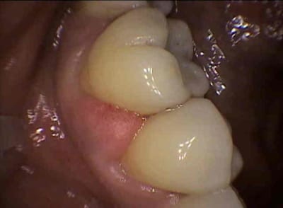 Berrube abces sfliaw - Eugenol