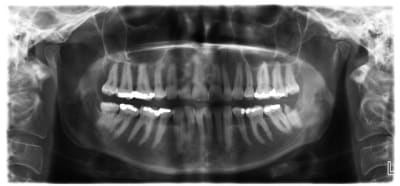 Blod npanxu - Eugenol