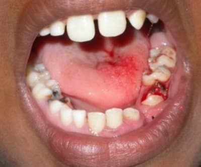 Bouche1 oygnwh - Eugenol