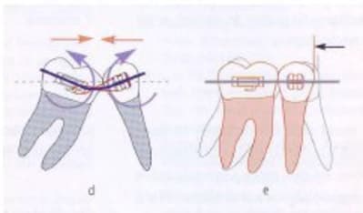 Bracket fjqdih - Eugenol