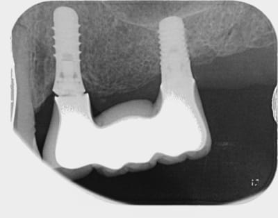 Bridge o7edur - Eugenol