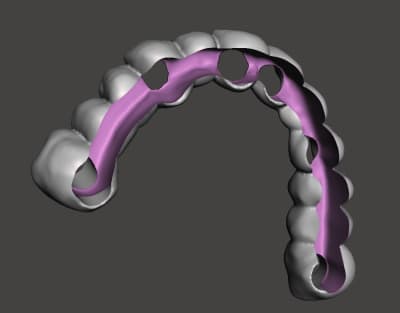 Bridge pour armature z4t0q9 - Eugenol