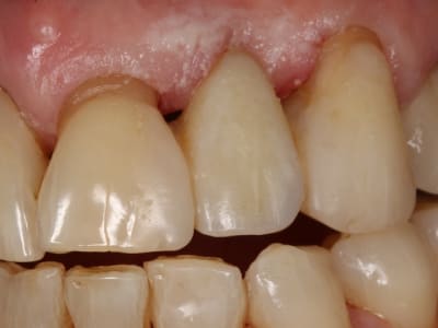 Bridge vectris 1 gdoui3 - Eugenol