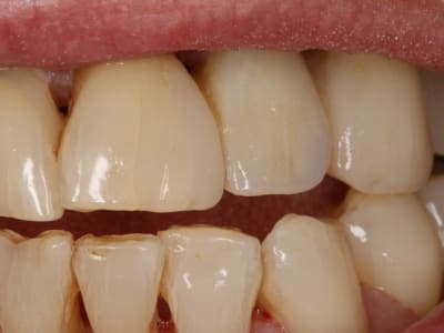 Bridge vectris aed5p4 - Eugenol