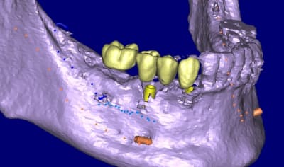 Canal 3d opaque sjglko - Eugenol