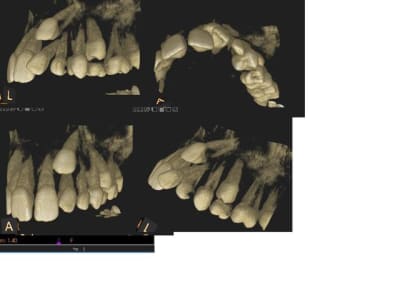 Canine incluse vjw34f - Eugenol