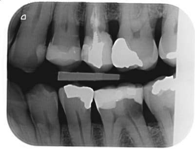 Carie3 e1basb - Eugenol