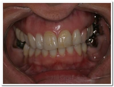 Cas clinique 001 dh1oa9 - Eugenol