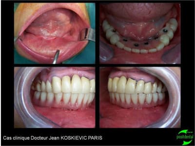 Cas clinique du dr jean koskievic 8 jvasax - Eugenol