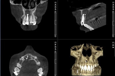 Cbct bqd3y6 - Eugenol
