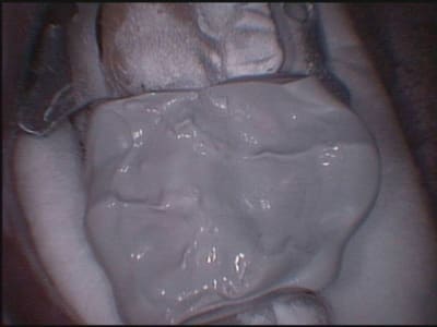 Cerec3 anhzje - Eugenol