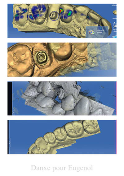 Cerec 4 ddtitr - Eugenol