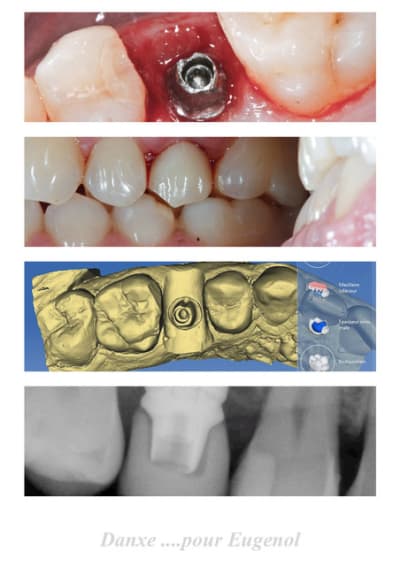 Cerec 7 gizme3 - Eugenol