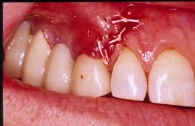 Chir i1evwd - Eugenol