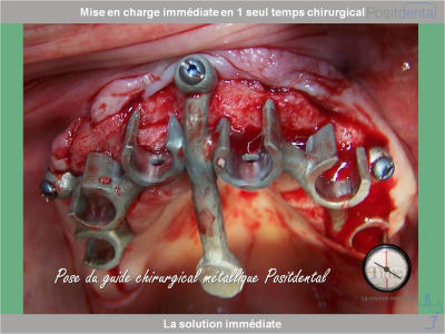 Chirurgie guidée mise en charge immédiate 0008 srbpgw - Eugenol