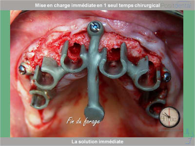 Chirurgie guidée mise en charge immédiate 0011 xmgnvv - Eugenol