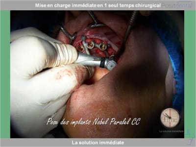 Chirurgie guidée mise en charge immédiate 0016 fqkazs - Eugenol