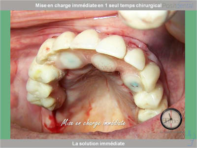 Chirurgie guidée mise en charge immédiate 0022 tbbes7 - Eugenol