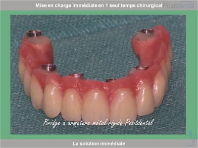 Chirurgie guidée mise en charge immédiate 0024 bzgic4 - Eugenol